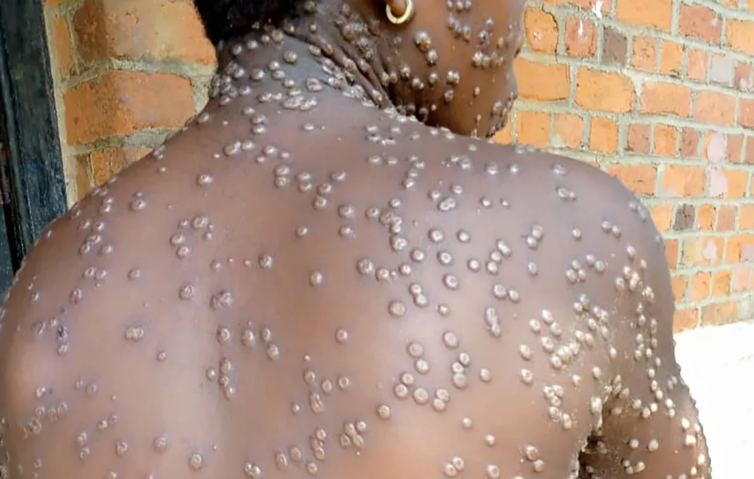 Variole du singe détectée dans le Golfe : comment se protéger